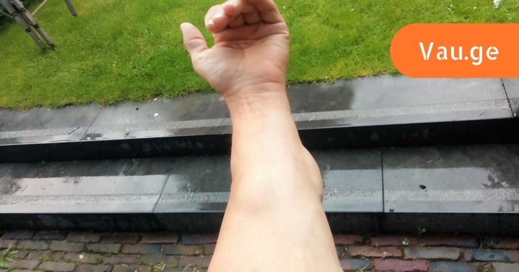 cximgrovebi-lipomebi