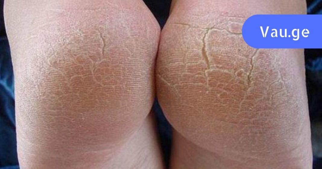 kuslebis-mkurnaloba (1)