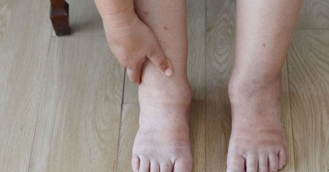 Leg Swelling Leg Swelling