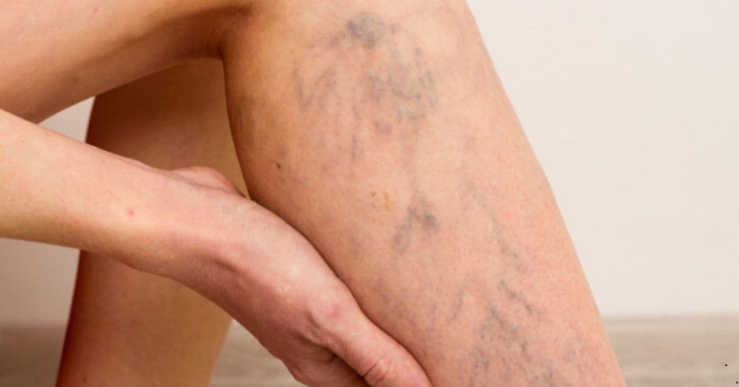 Varicose Veins Get Rid of Varicose Veins