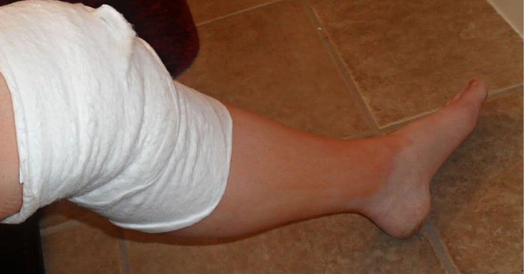 bandage for knee pain knee pain