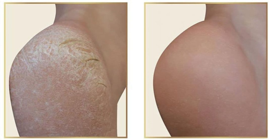 ქუსლის მკურნალობა