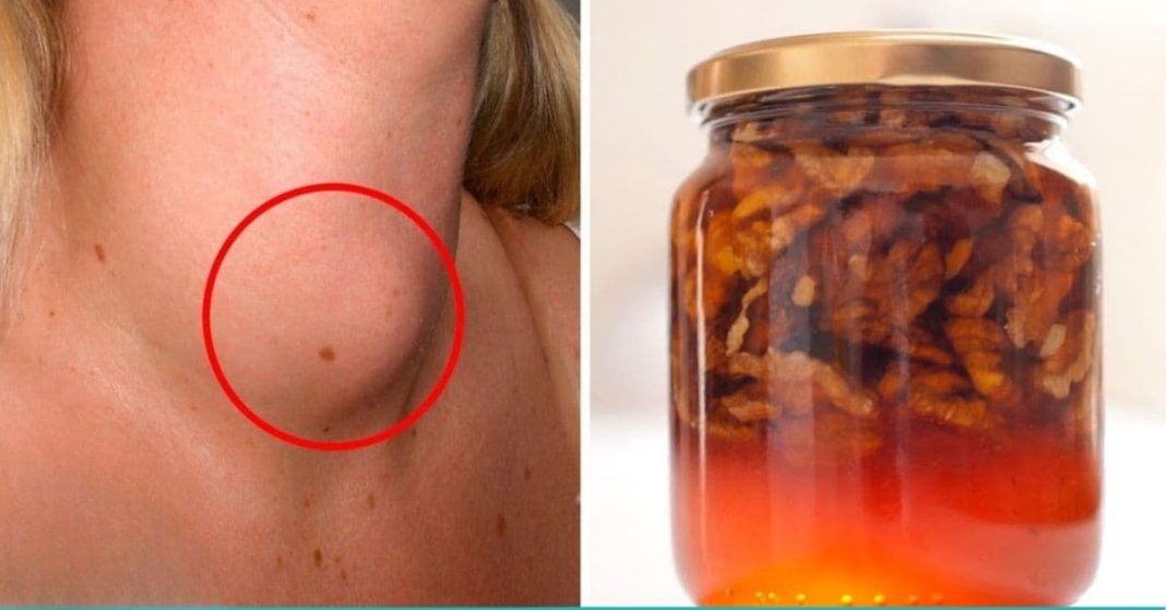 ფარისებრი ჯირკვალი