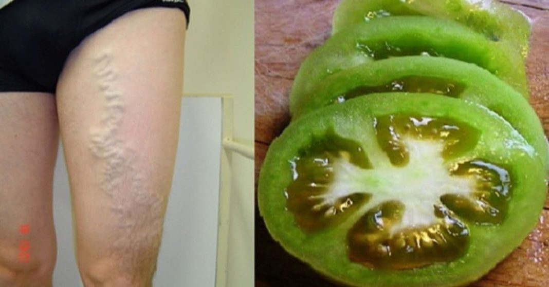 ვარიკოზული ვენები