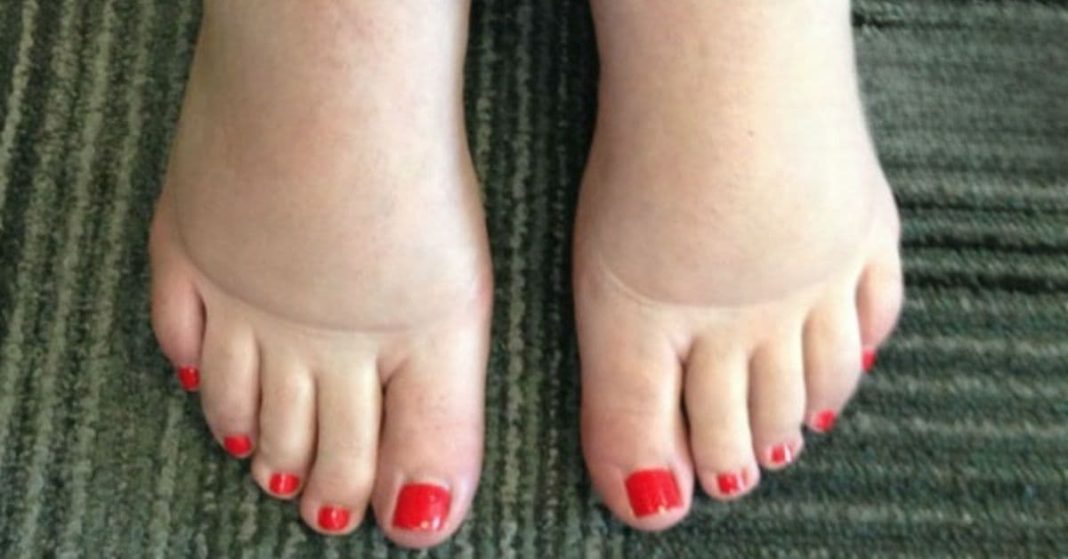 შეშუპებული ფეხი