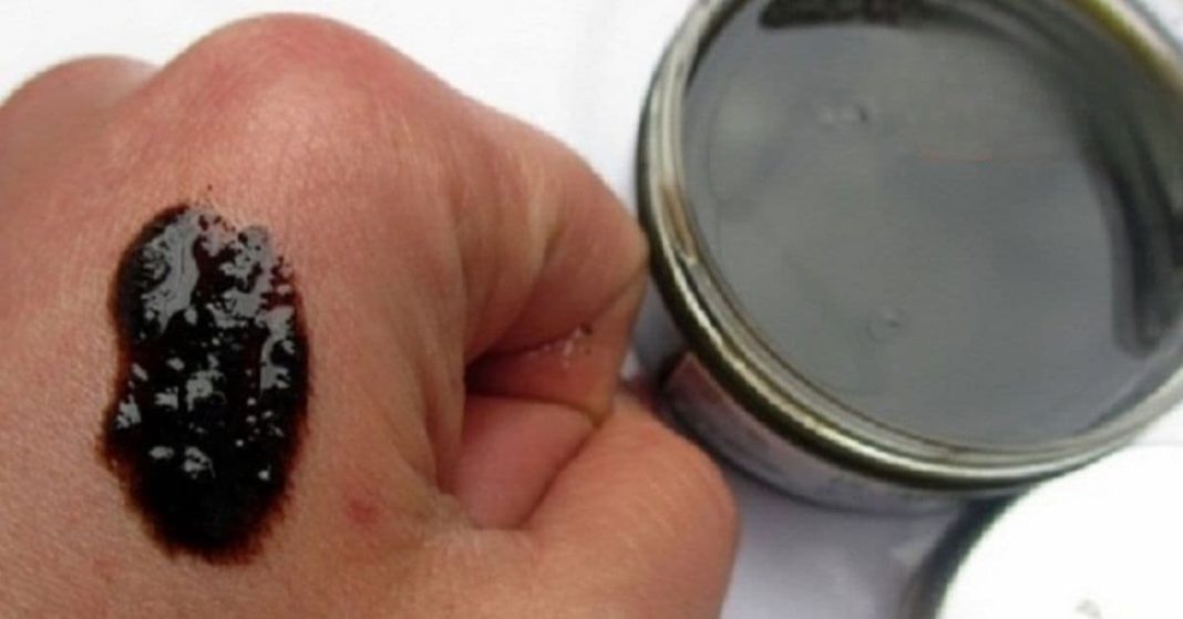 ფსორიაზი