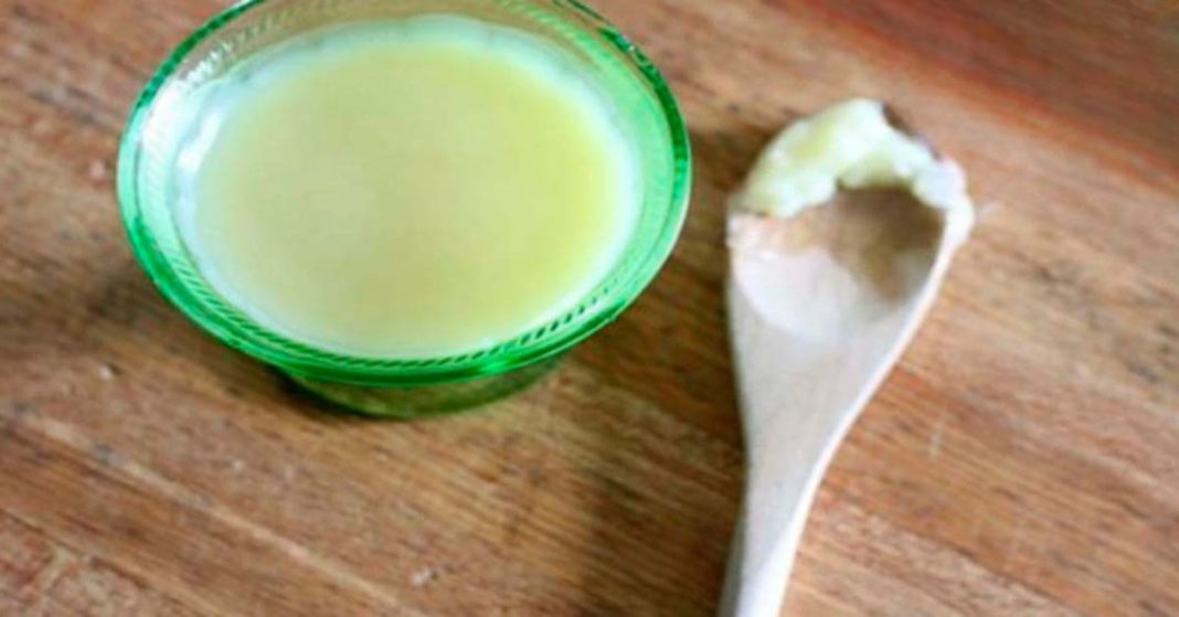 რადიკულიტი