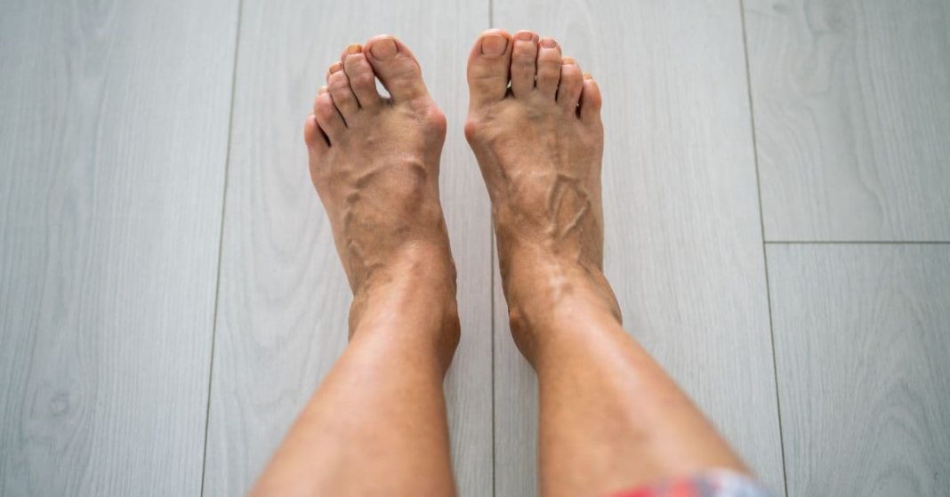 ბუნიონი