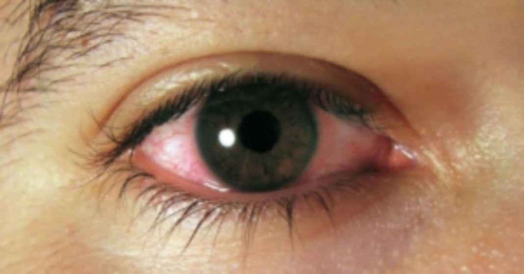 თვალის დაავადება