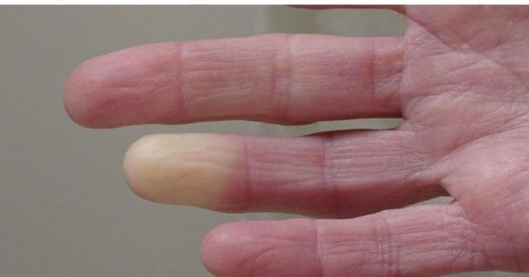 ხელებზე ფერის ცვლილება