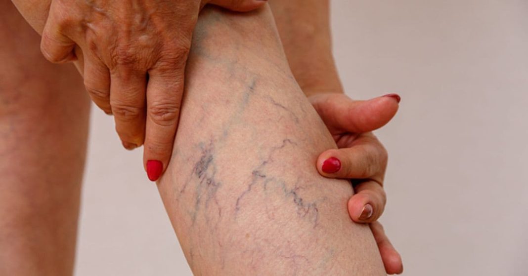 ვარიკოზული ვენები