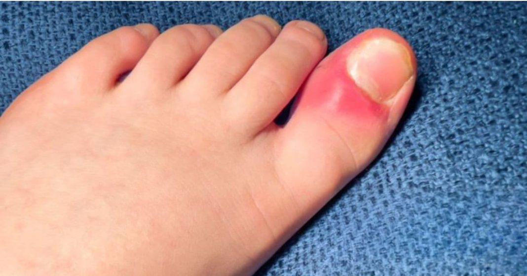 ჩაზრდილი ფრჩხილი