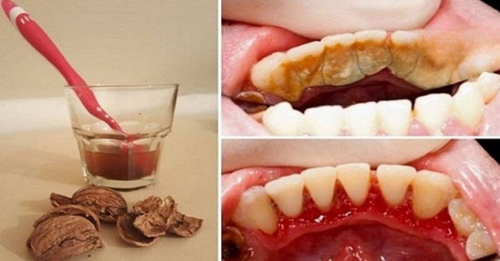 Stones and plaque from teeth