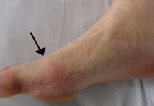 Easily get rid of uric acid crystals and forget about gout forever!
